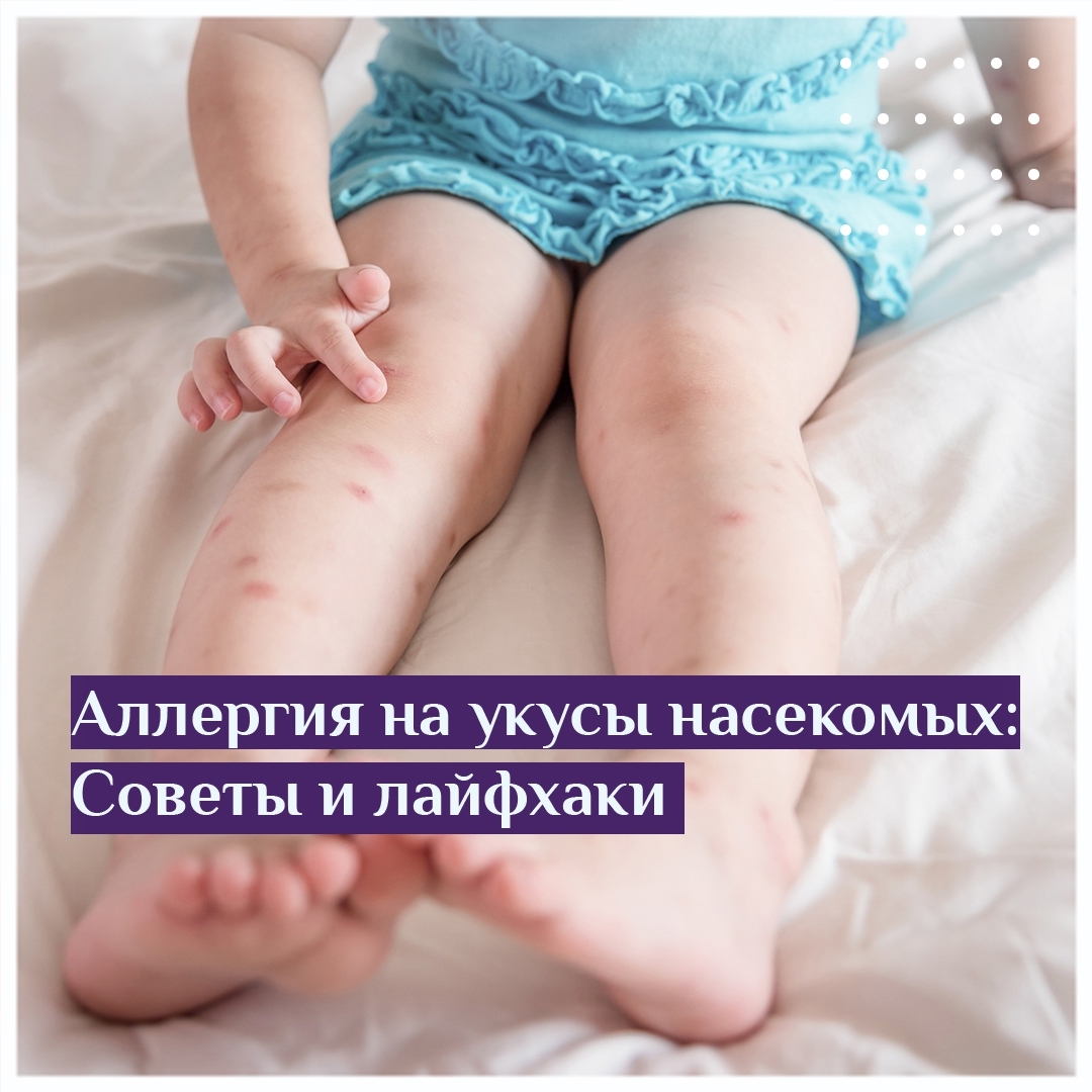 Аллергия на укусы насекомых советы и лайфхаки